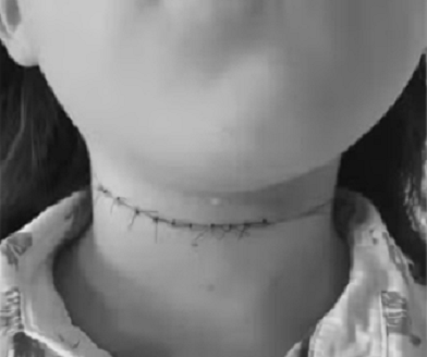 pescoco_de_menino_cortado_por_linha_de_cerol