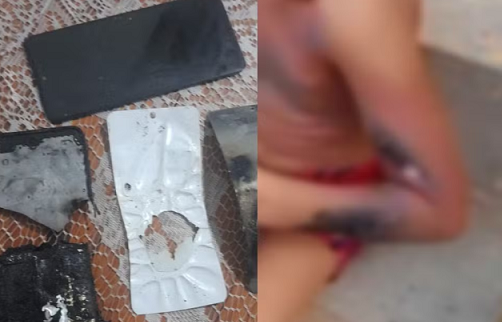 queimadura_por_explosao_de_celular