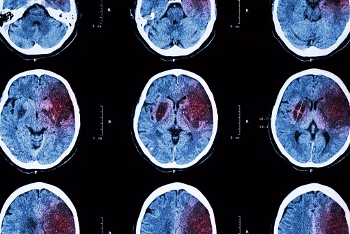 tomografia_de_cerebro-avc